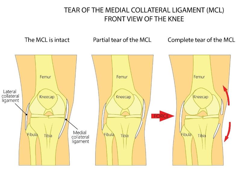 Medial Collateral Ligament MCL Tear